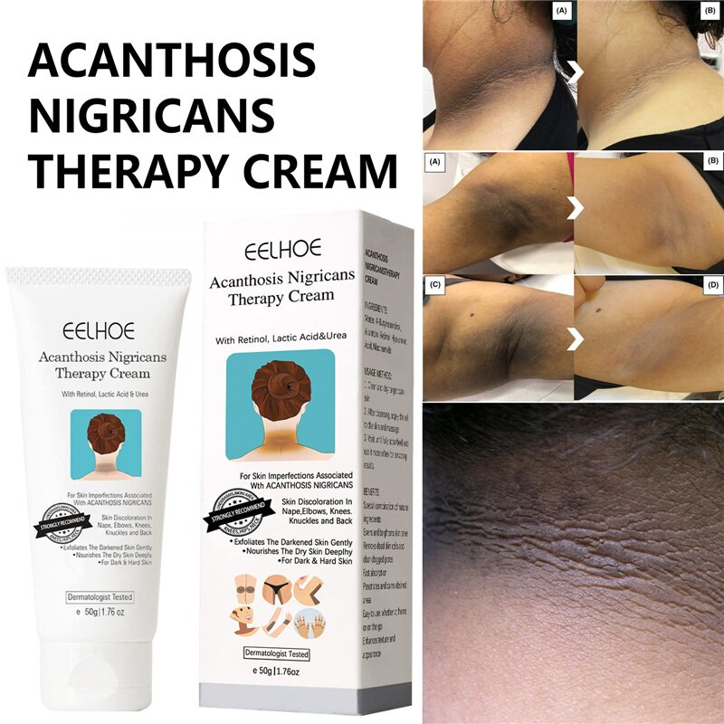Acanthosis Nigricans Therapy Cream Removing Dark Elbow Knee Spots Ankle Corner รักแร้ Body Cream Underarm Arm Joint Dark Spot Corrector - 50g