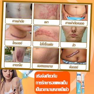 การกำจัดรอยแผลเป็นด้วยเลเซอร์, ลดรอยแผลเป็น, การกําจัดรอยแผลจากสิว, ลดแตกลาย, ลดเลเซอร์, รักษาเป็น, การกําจัดผ่าตัด
