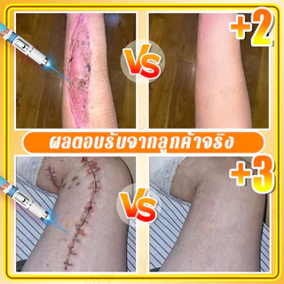 การกำจัดรอยแผลเป็นด้วยเลเซอร์, ลดรอยแผลเป็น, การกําจัดรอยแผลจากสิว, ลดแตกลาย, ลดเลเซอร์, รักษาเป็น, การกําจัดผ่าตัด
