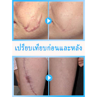 [กำจัดรอยแผลเป็น] ครีมลบรอยแผลเป็นอย่างรวดเร็ว เหมาะสำหรับการซ่อมแซมผิวจากรอยแผลเป็นจากการเสียดสี จากไฟไหม้ หลังผ่าตัด แตกลาย ฯลฯ
