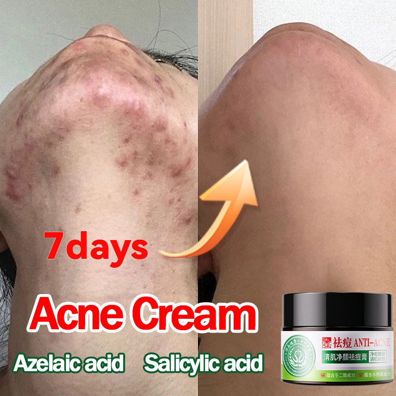 จัดส่งรวดเร็วครีมกําจัดสิวที่มีประสิทธิภาพ ประกอบด้วย Azelaic Acid Salicylic Acid acne/รอยสิว/หลุมสิว สกินแคร์ ครีมแต้มสิววัยรุ่น 30g