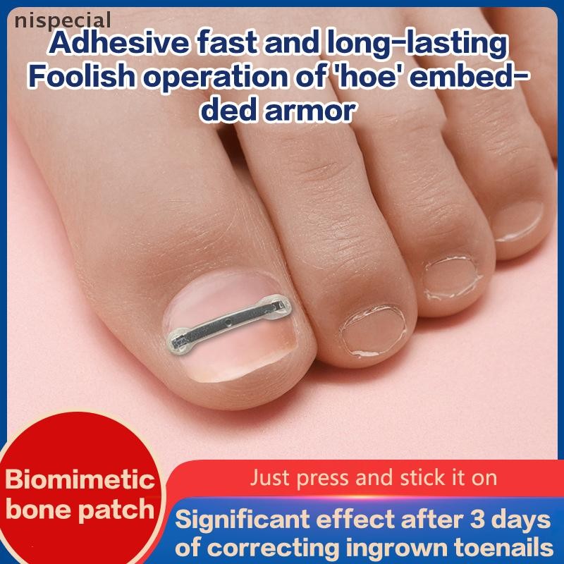 [nispecial] 6/12 ชิ้นคุดเล็บเท้า Corrector เครื่องมือคุด Toe Nail Treatment สติกเกอร์แพทช์ยืดหยุ่นยืดคลิปรั้งเครื่องมือทําเล็บเท้า [MY]