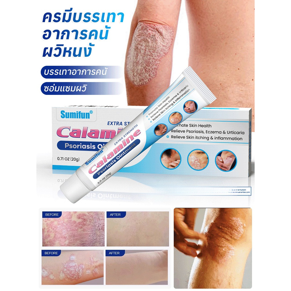 💥ลด 50%/COD💥 ครีมบำรุงผิว-บรรเทาอาการคันจากโรคผื่นภูมิแพ้และโรคผิวหนังอักเสบ/สูตรอ่อนโยน ออกฤทธิ์เร็ว/ครีมบรรเทาอาการคันจากโรคสะเก็ดเงินและโรคผิวหนังอักเสบ เหมาะสำหรับผิวแพ้ง่าย