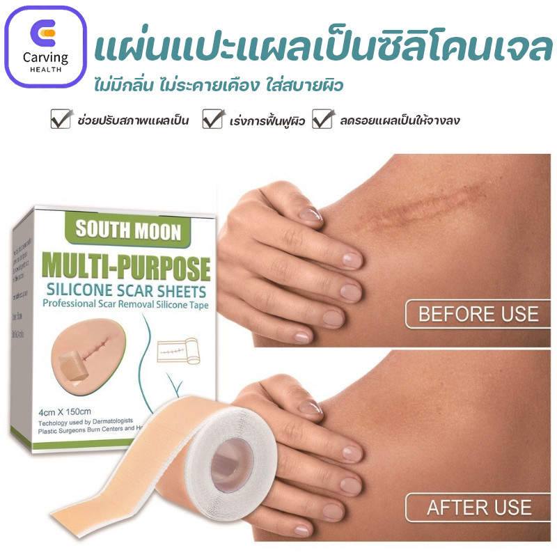 COD แผ่นแปะแผลเป็น แผ่นแปะรักษาแผลเป็น กันน้ำ สำหรับการแพทย์หลังการผ่าตัดคลอด ลบรอยแผลเป็นแผลผ่าตัด silicone scar
