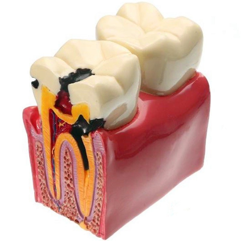 6 Times Dental Model Teeth Model Caries Comparation Study Models School Research Presentation