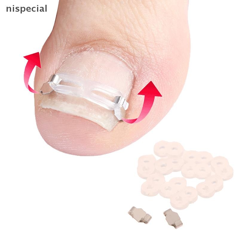 [nispecial] 1 ชุดคุด Toenail Corrector เครื่องมือ Pedicure Recovered Toenail Treatment Professional Foot Care Correction เครื่องมือ [MY]