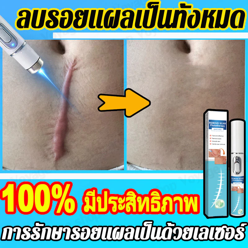 การกำจัดรอยแผลเป็นด้วยเลเซอร์, ลดรอยแผลเป็น, การกําจัดรอยแผลจากสิว, ลดแตกลาย, ลดเลเซอร์, รักษาเป็น, การกําจัดผ่าตัด