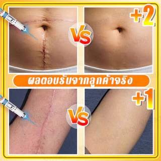 การกำจัดรอยแผลเป็นด้วยเลเซอร์, ลดรอยแผลเป็น, การกําจัดรอยแผลจากสิว, ลดแตกลาย, ลดเลเซอร์, รักษาเป็น, การกําจัดผ่าตัด