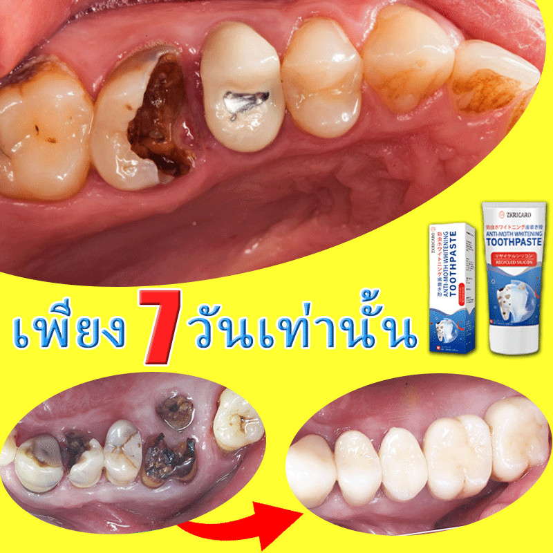 ทําความสะอาดช่องปากอย่างล้ําลึก สร้างชิลด์ป้องกันฟัน บอกลาฟันผุ ปกป้องเหงือก
