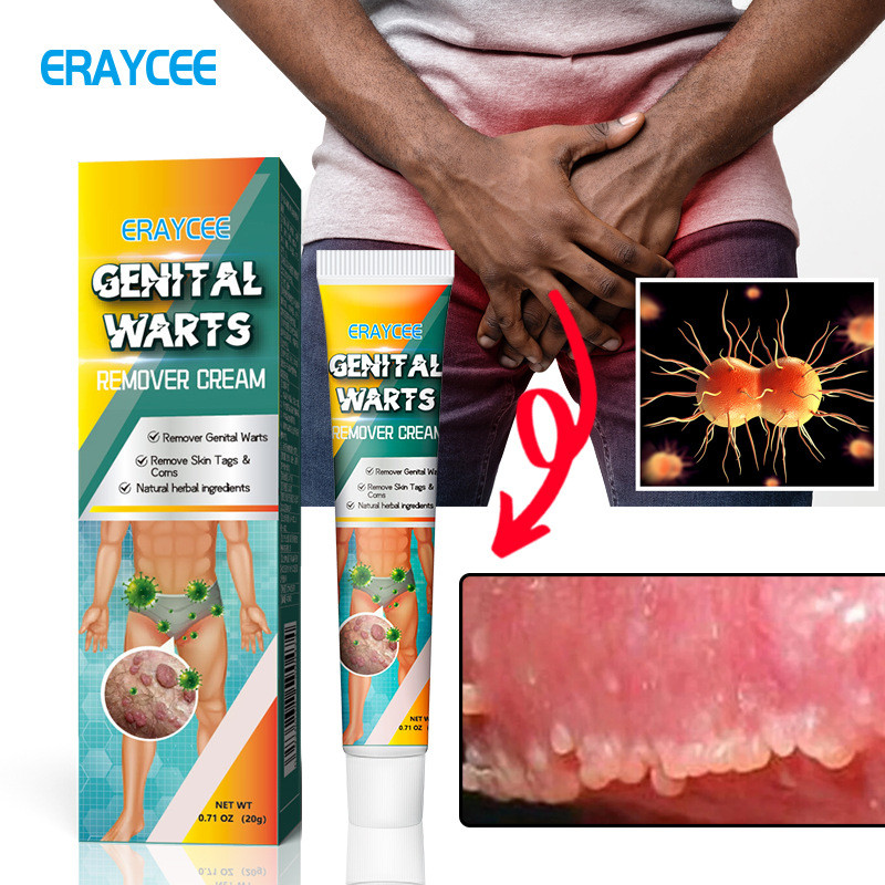 ERAYCEE สมุนไพรผู้ชายผู้หญิง Private Part Wart Removal Agent Ke Wart ครีม Pinghou Euro Wart Removal 