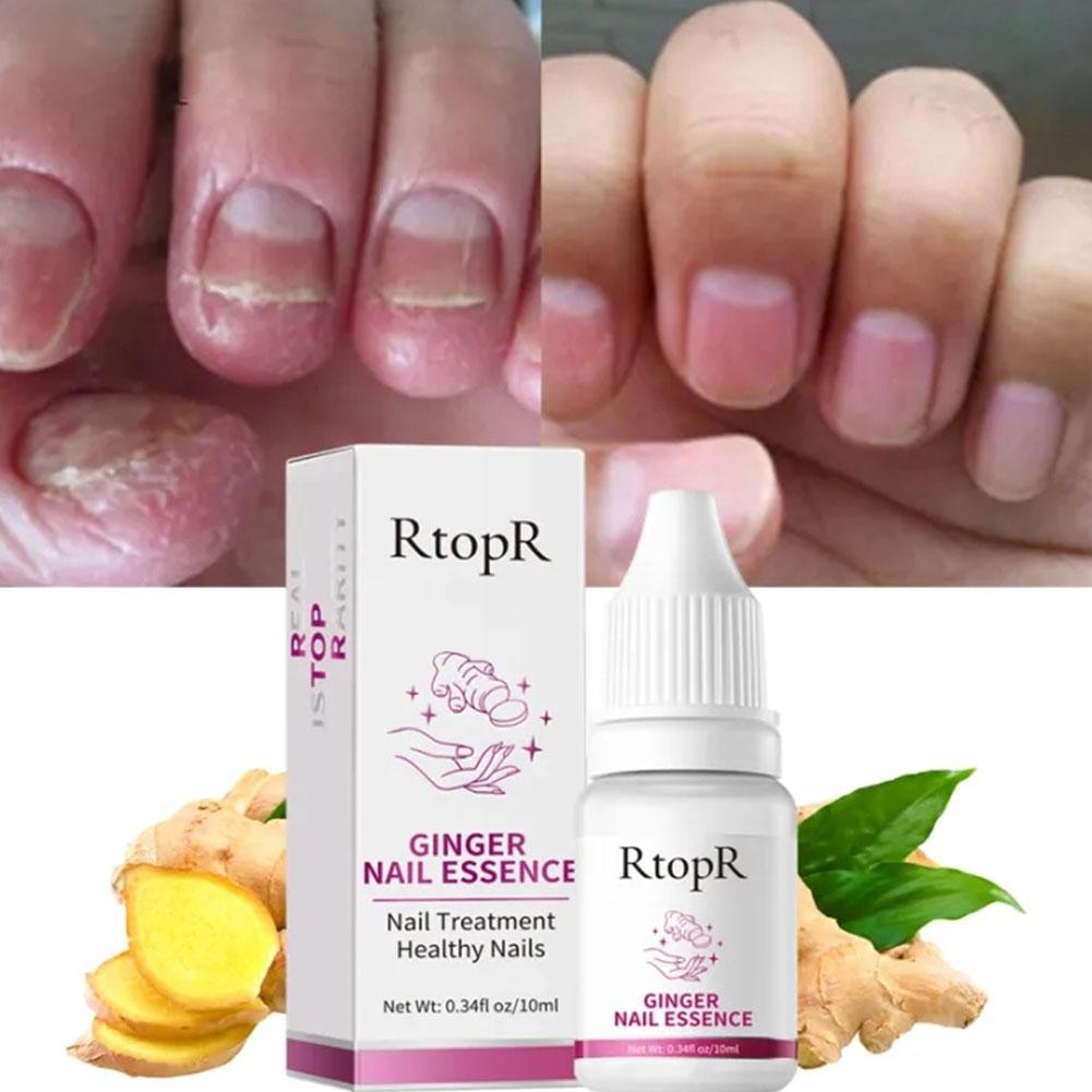 RtopR Ginger Nail Essence Anti Infection Paronychia Treatment Nail G1M7