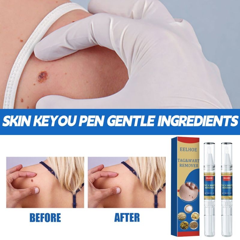 Original warts Remover Watson warts removal mole and warts Remover แท็กผิวและ warts Remover wartz Re