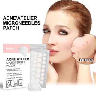 Spot# OUHOE acne patch repair acne acne acne acne acne facial redness cleaning pores moisturizing smooth skin acne patch 8jj