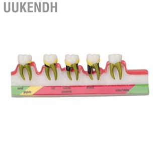 Uukendh Dental Periodontal Disease Model Resin  For Tooth Study