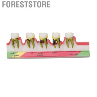 Foreststore Dental Periodontal Disease Model Resin  For Tooth Study