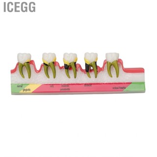 Icegg Dental Periodontal Disease Model Resin  For Tooth Study