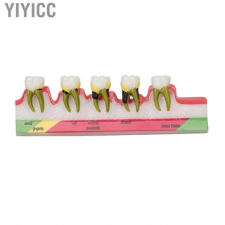 Yiyicc Dental Periodontal Disease Model Resin  For Tooth Study