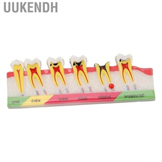 Uukendh Caries Development Model 6 Stages  For Dental Clinic