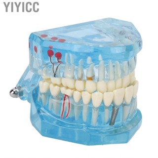 Yiyicc Dental Pathological Model Clear Teaching Detachable  Display B