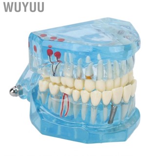 Wuyuu Dental Pathological Model Clear Teaching Detachable  Display B