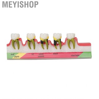 Meyishop Dental Periodontal Disease Model Resin  For Tooth Study