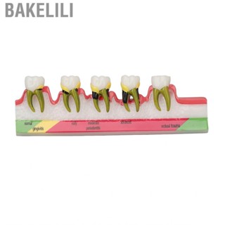 Bakelili Dental Periodontal Disease Model Resin  For Tooth Study