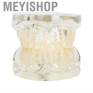 Meyishop Dental Implant Restoration Typodont  Model Removable Study Demo