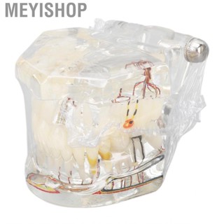 Meyishop Disease Implant  Model Dental