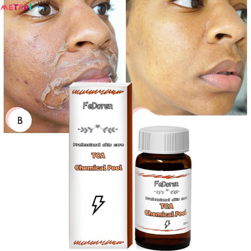 Tca Peeling Solution 30% 50% 70% 30ml/ปลอดภัยสำหรับผิว/ขจัดฝ้าสิวรอยแผลเป็นจากสิว metro1