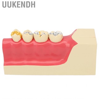 Uukendh Right Lower Posterior Dental Model Sick Pulp Detachable  Anatomical 2X Magnification Resin for Teaching Aids