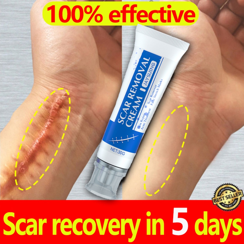 Remover For Old Leg Gel ครีมรักษาสิวแบรนด์เดิมจางหายไป รอยไหม้และน้ำร้อนลวกใหม่โดยไม่ทิ้ง