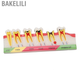 Bakelili Caries Development Model 6 Stages  For Dental Clinic