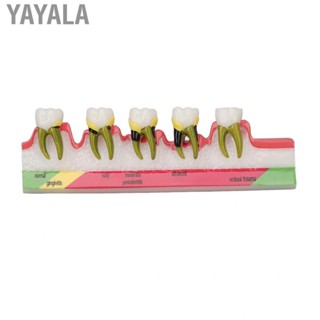 Yayala Periodontal Disease Model Better Understand  High  Clearly Display for Teaching Aids