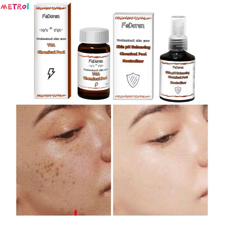 Tca Chemical Peel Solution 30% 50% 70% 30ml 50ml ขจัดฝ้าสิวรอยแผลเป็นจากสิวซีดจางสิวกล้ามเนื้อสิว me