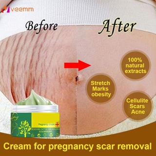 การตั้งครรภ์ Stretch Mark Repair ครีมคลอดบุตรโรคอ้วนผิวหลังคลอดยืดรอยแผลเป็น Body Marks Remover Smooth Skin Care veemm