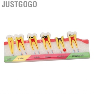 Justgogo Caries Development Model 6 Stages  For Dental Clinic