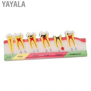 Yayala Caries Development Model 6 Stages  For Dental Clinic