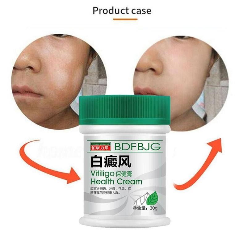 การจัดส่งที่รวดเร็ว~Vitiligo ครีมพลาสเตอร์เมลานิน รักษาโรคผิวหนัง จุดด่างดํา 30 มล.