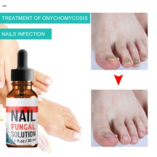 ✧ready Stcok Eelhoe Nail Fungal Repair Feet Care Treatments Anti-fungal Liquid nuuo