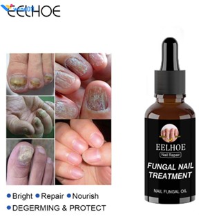 Eelhoe Nail Care Essence 30/50ml ฆ่าเชื้อรากลายพันธุ์ลึก Healthy Toenails ใช้ More Complete Ginger wine011