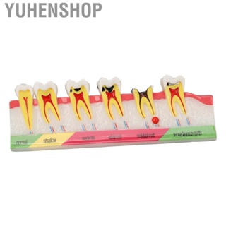 Yuhenshop Caries Development Model 6 Stages  For Dental Clinic