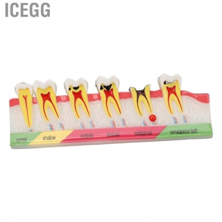Icegg Caries Development Model 6 Stages  For Dental Clinic