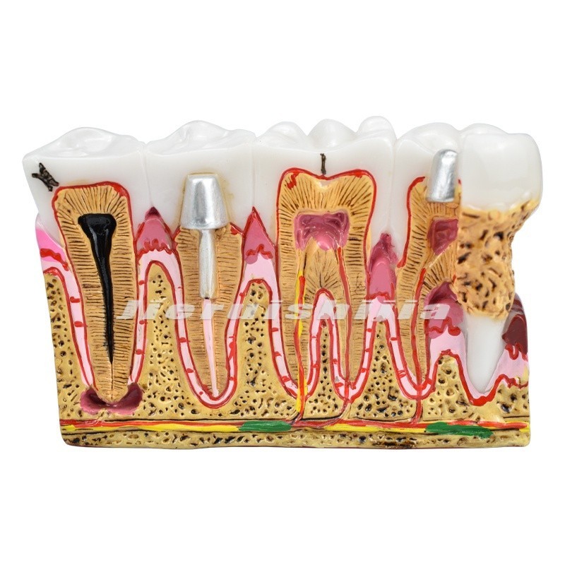 โมเดลฟัน รุ่น Caries สําหรับทันตกรรม สอนทันตกรรม