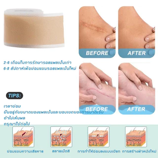 แผ่นแปะแผลเป็น ซิลิโคนรอยแผลเป็นแผ่น 1 ม้วน (4X150 ซม.) กําจัดรอยแผลเป็นจากแผลเป็น กันน้ำ