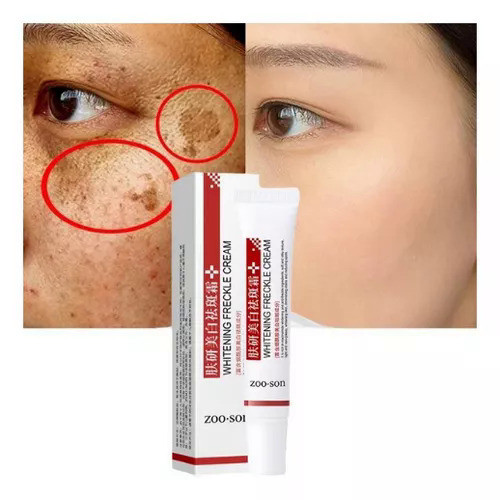 Whitening Chloasma Spots Acne Freckles จุดด่างดํา