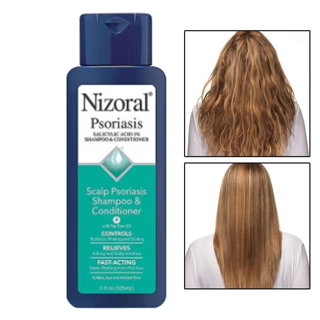 แชมพูและครีมนวดขจัดรังแค Nizoral ขนาด 325 มล. ครีมนวดขจัดรังแค ครีมนวดบรรเทาอาการคัน