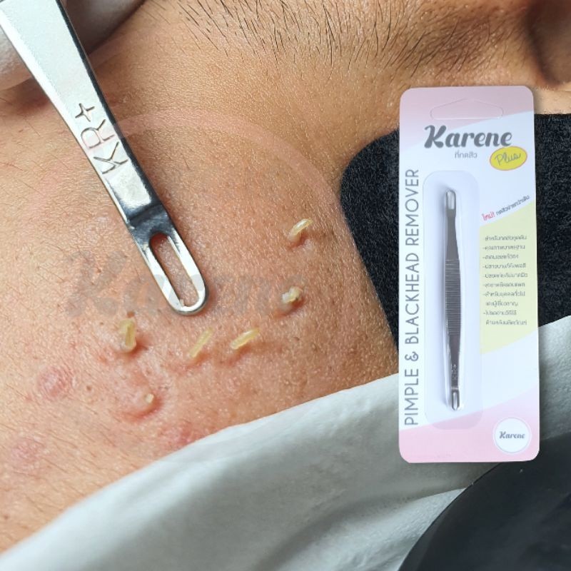 บีบสิวง่าย ที่กดสิวคารีนรุ่นพีท..ฟรี..ตัวช่วยเปิดสิว10ชิ้น สุดคุ้ม ‼️Kareneไม้กดสิว ส่งจากคลินิก กดง
