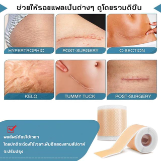 แผ่นแปะแผลเป็น ซิลิโคนรอยแผลเป็นแผ่น 1 ม้วน (4X150 ซม.) กําจัดรอยแผลเป็นจากแผลเป็น กันน้ำ