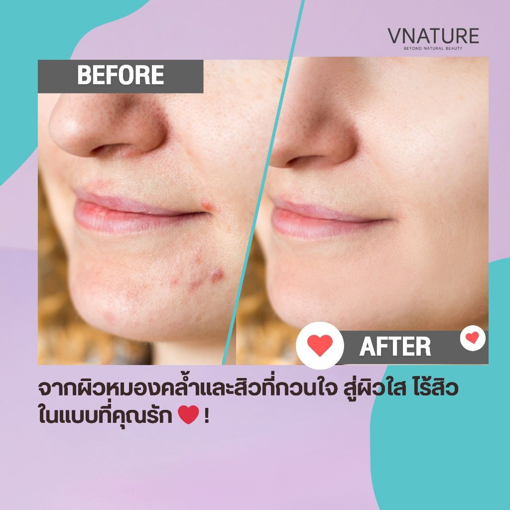 สบู่ลดสิว รอยสิว VNATURE Pimple&Whitening Soap สิวอุดตัน สิวอักเสบ ลดสิวผด สิวหลัง สบู่แก้สิว ผิวใส รูปที่ 7