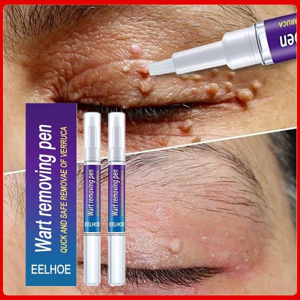2 ชิ ้ น Wart Wart Remover ของเหลวกําจัดข ้ าวโพด